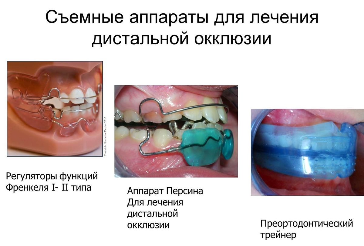 Дистальный (верхние зубы впереди нижних) и глубокий прикус