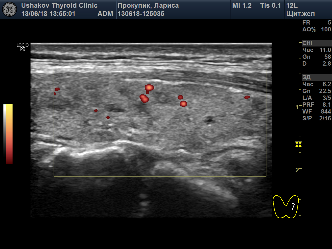 Узи картина тиреоидита