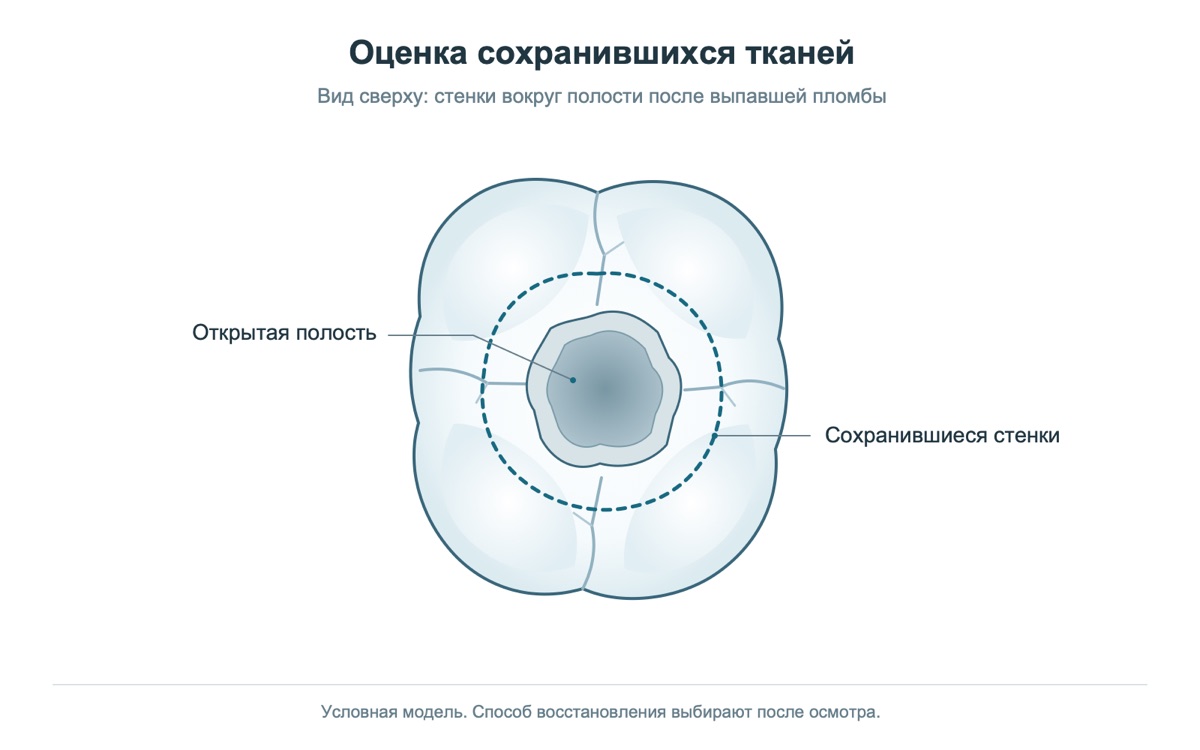 Учебная модель зуба: открытая полость и сохранившиеся стенки, которые оценивают перед восстановлением