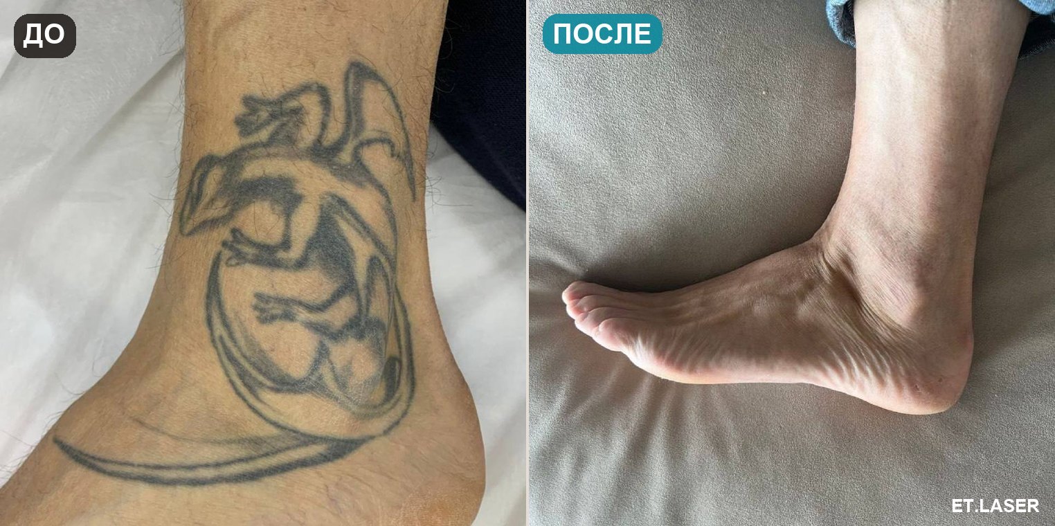 До и после: тату на стопе