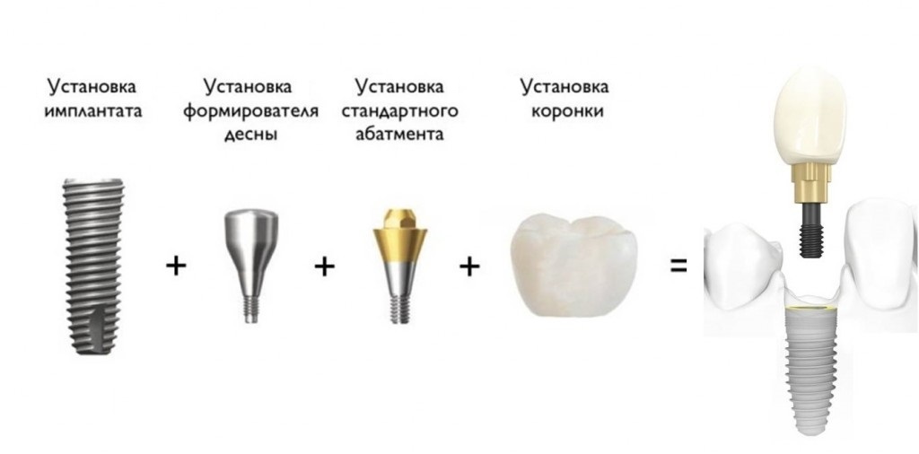 Имплантация схема установки зубов