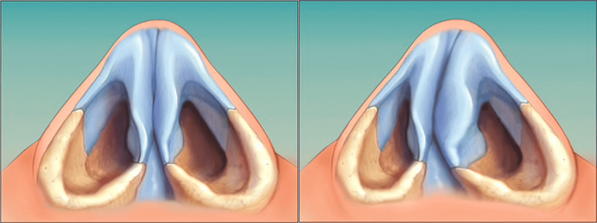 Дистопия носовой перегородки