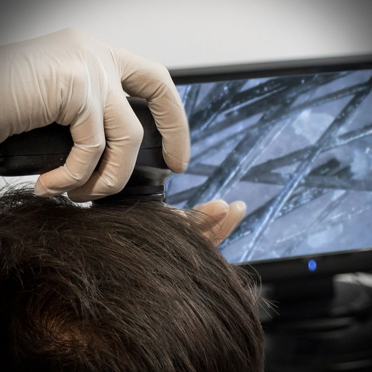 выпадение волос диагностика лечение