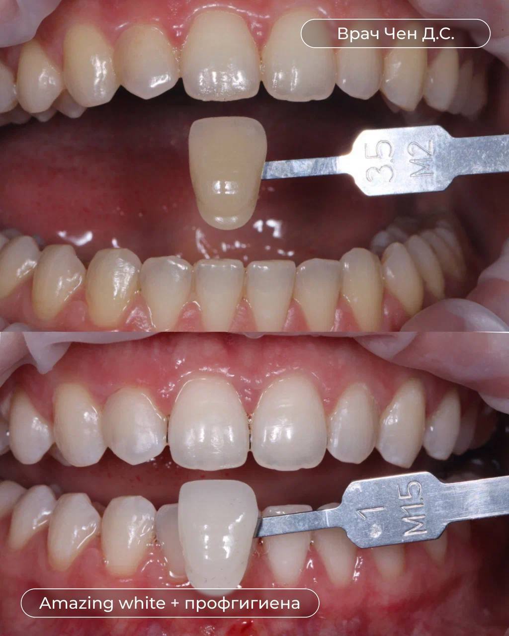 Лечение кариеса и изменение цвета зуба - до и после