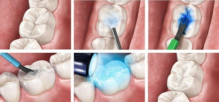 Что такое световая пломба? Отличия от обычной химической пломбы