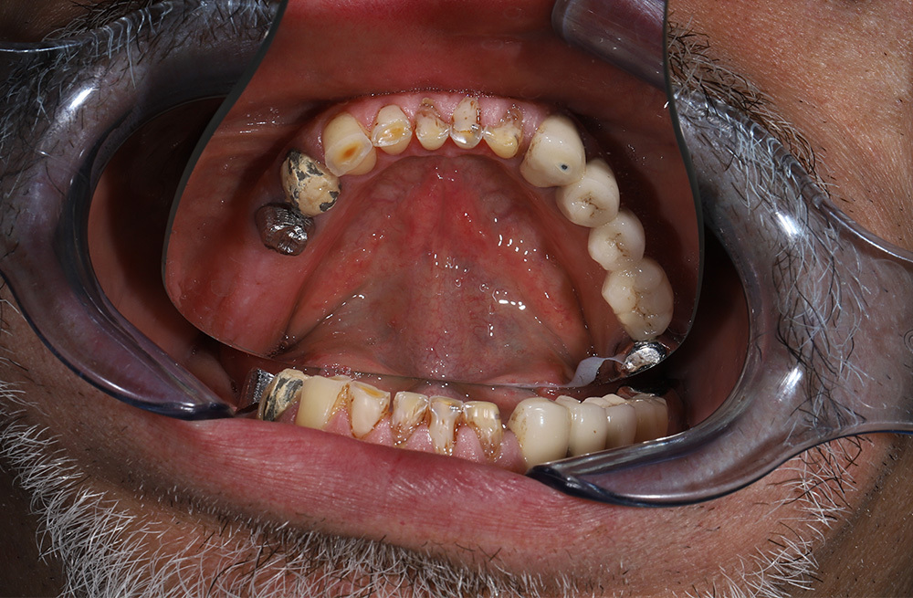 Имплантация верхней и нижней челюстей на 6 имплантах