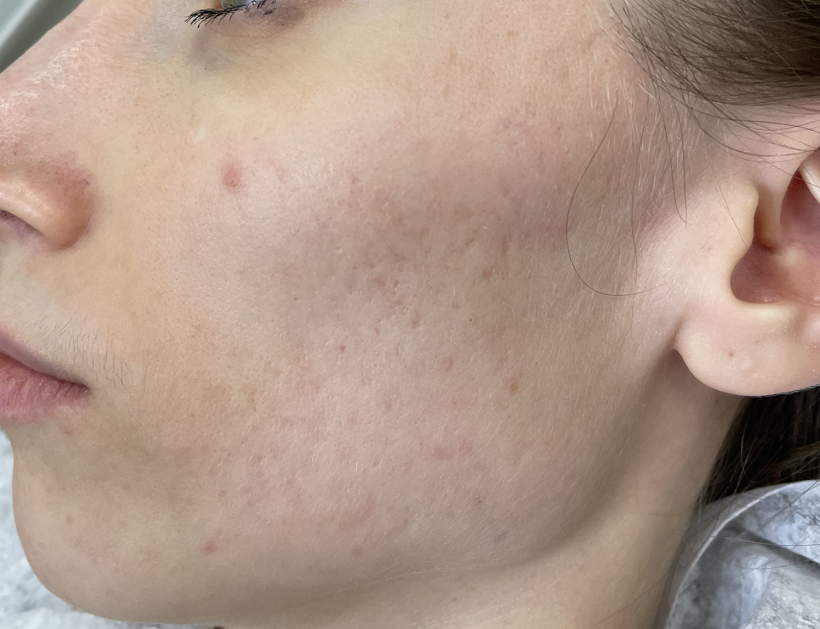 После — рубец 2