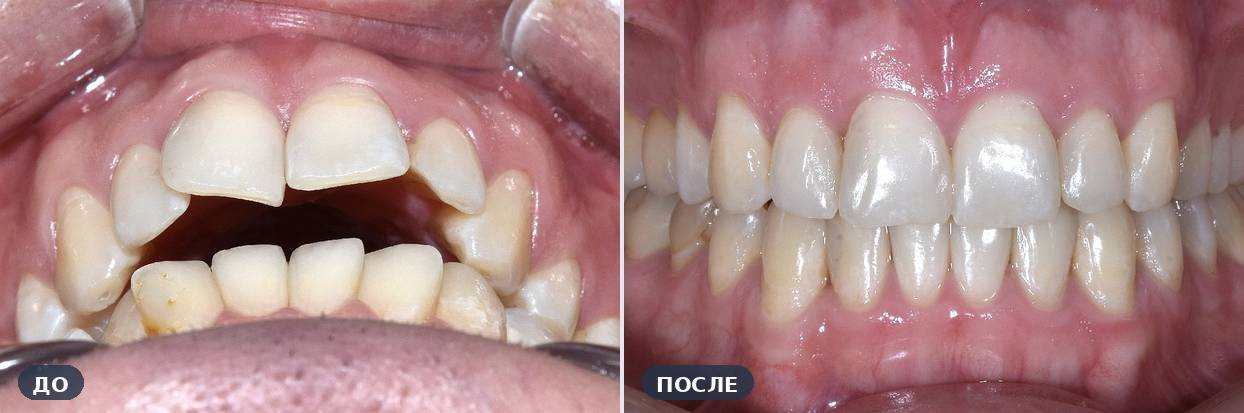 Ортодонтическое лечение: Открытый прикус — до и после