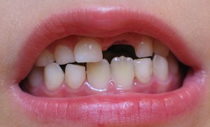 Особенности смены зубов