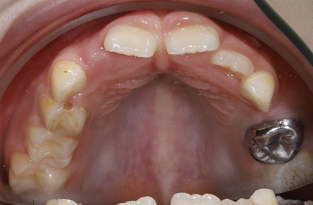 Ортодонтическое лечение у ребенка на несъемном аппарате HAAS