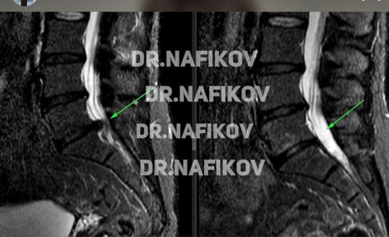 МРТ до и после лечения, Пациент Г., 54 года