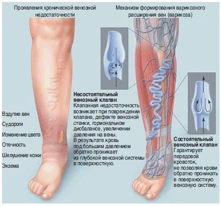 Баня при экземе на руках и ногах