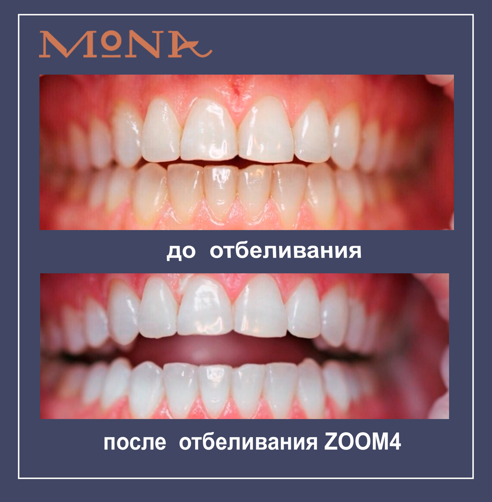 Лазерное отбеливание зубов Томск Ново-Киевская 1-я Лечение периостита Томск Мало-Кирпичный