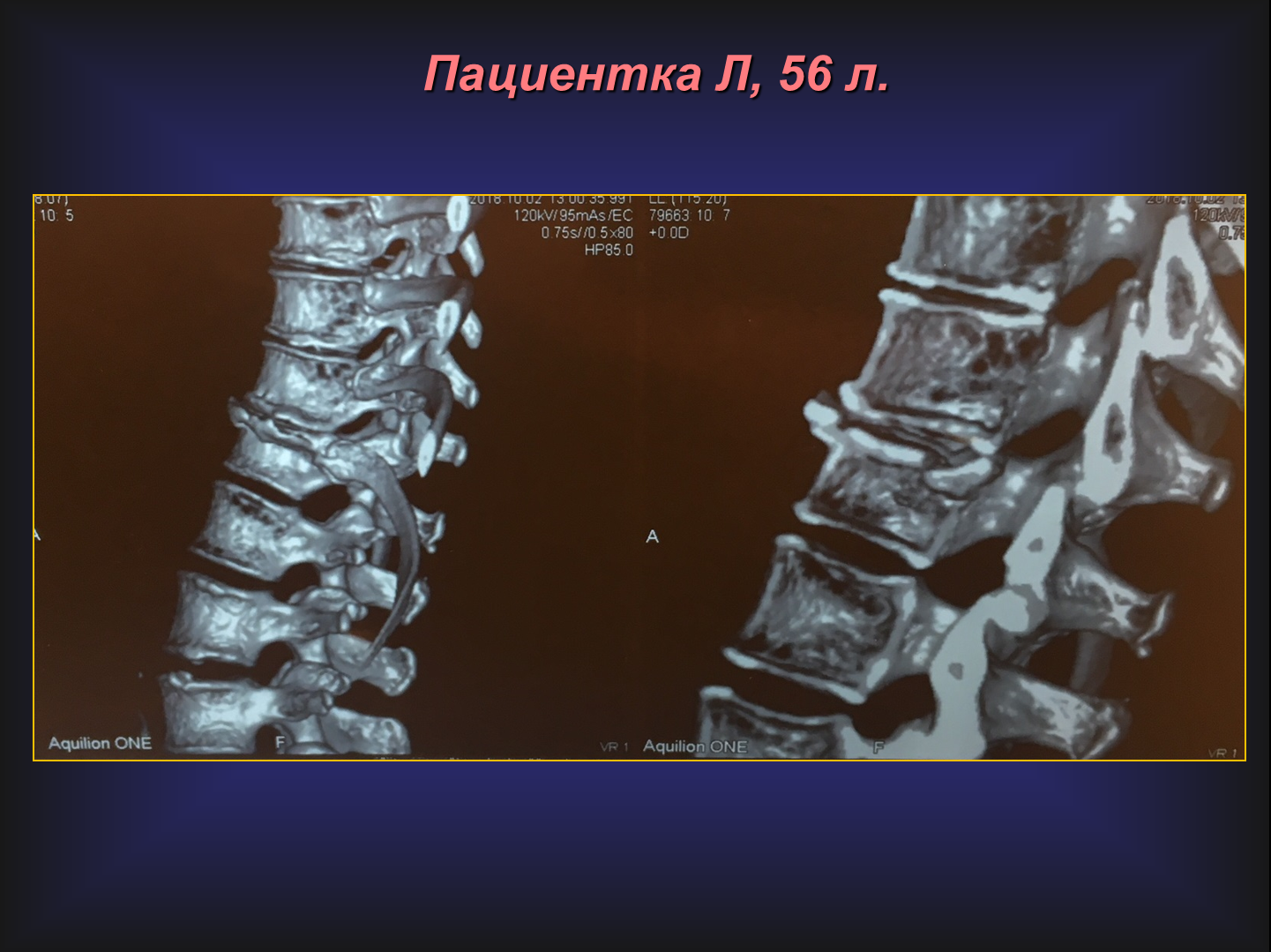 Перелом грудного отдела позвоночника