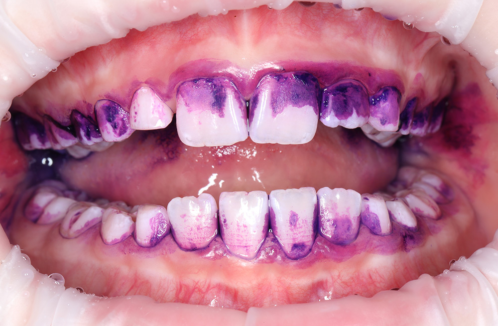 Профгигиена, лечение кариеса композитным материалом ребенку 7 лет