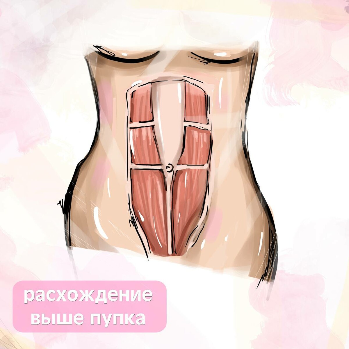 2_6. Выпирающий живот и диастаз. Что делать?