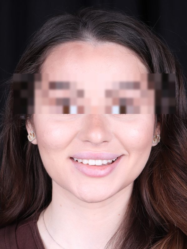 Исправление прикуса — фото после лечения, Elite Denta