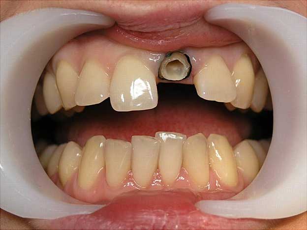 Нарастить жевательный зуб пломбой или поставить коронку: что лучше