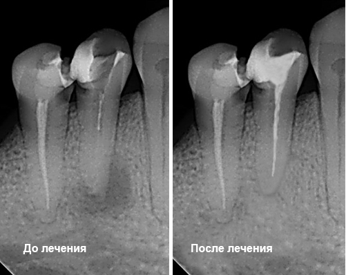 Лечу каналы. Периодонтит зуба рентген до и после. Кариес корня зуба рентген. Пульпит и периодонтит рентген.