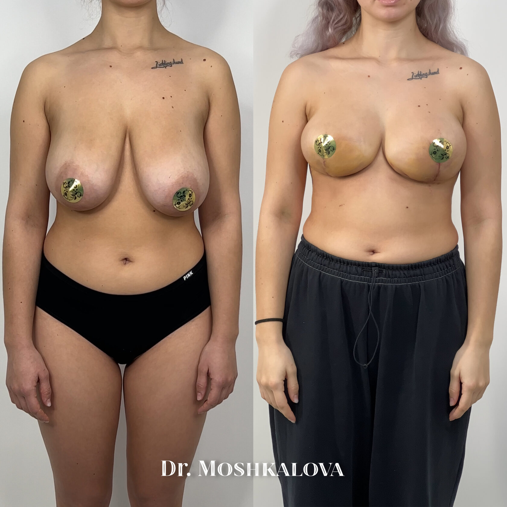 как увеличить одну грудь без операции фото 23
