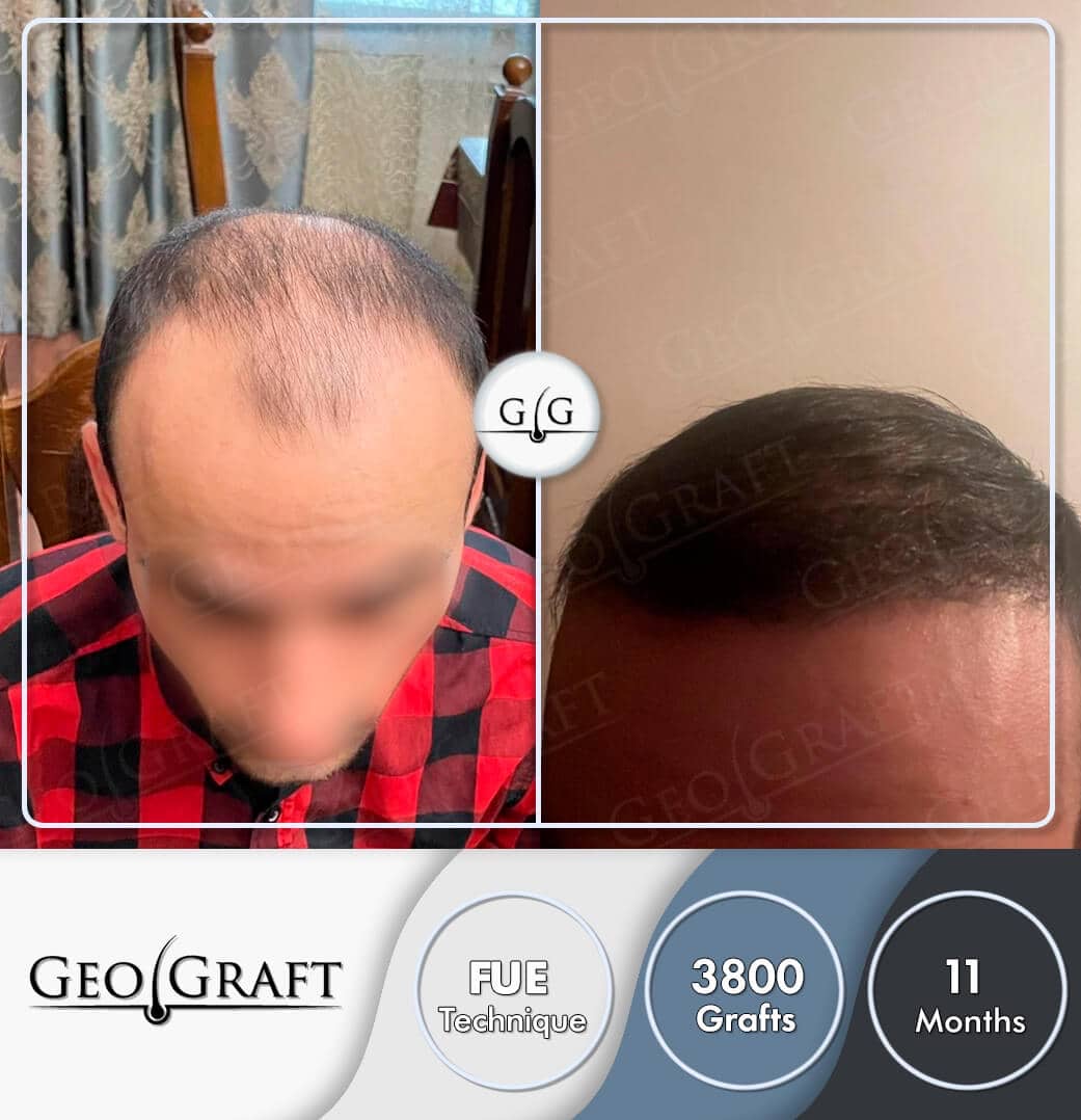 Пересадка волос в Москве. Geograft. Без боли - за один день.