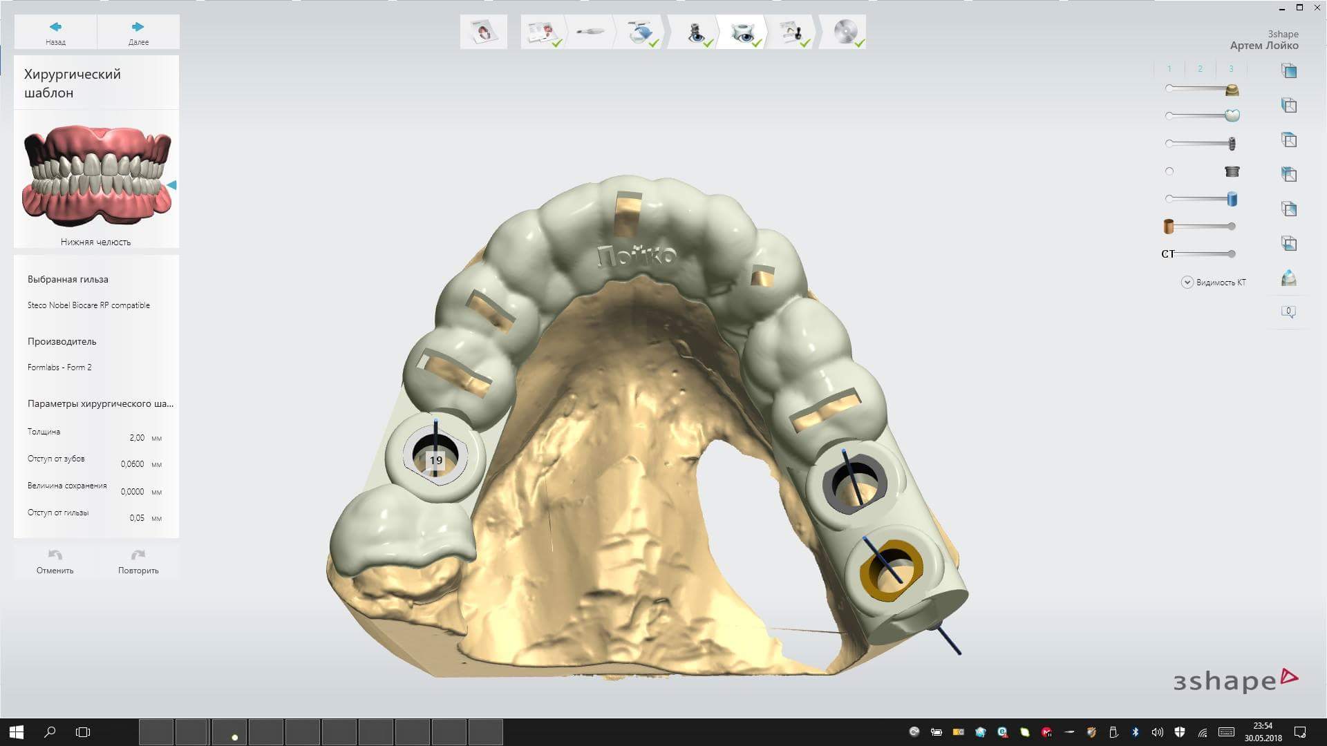 Хирургические импланты. Хирургический шаблон 3shape. Хирургический шаблон для имплантации. Изготовление хирургического шаблона для имплантации. Стоматологический шаблон для имплантации.