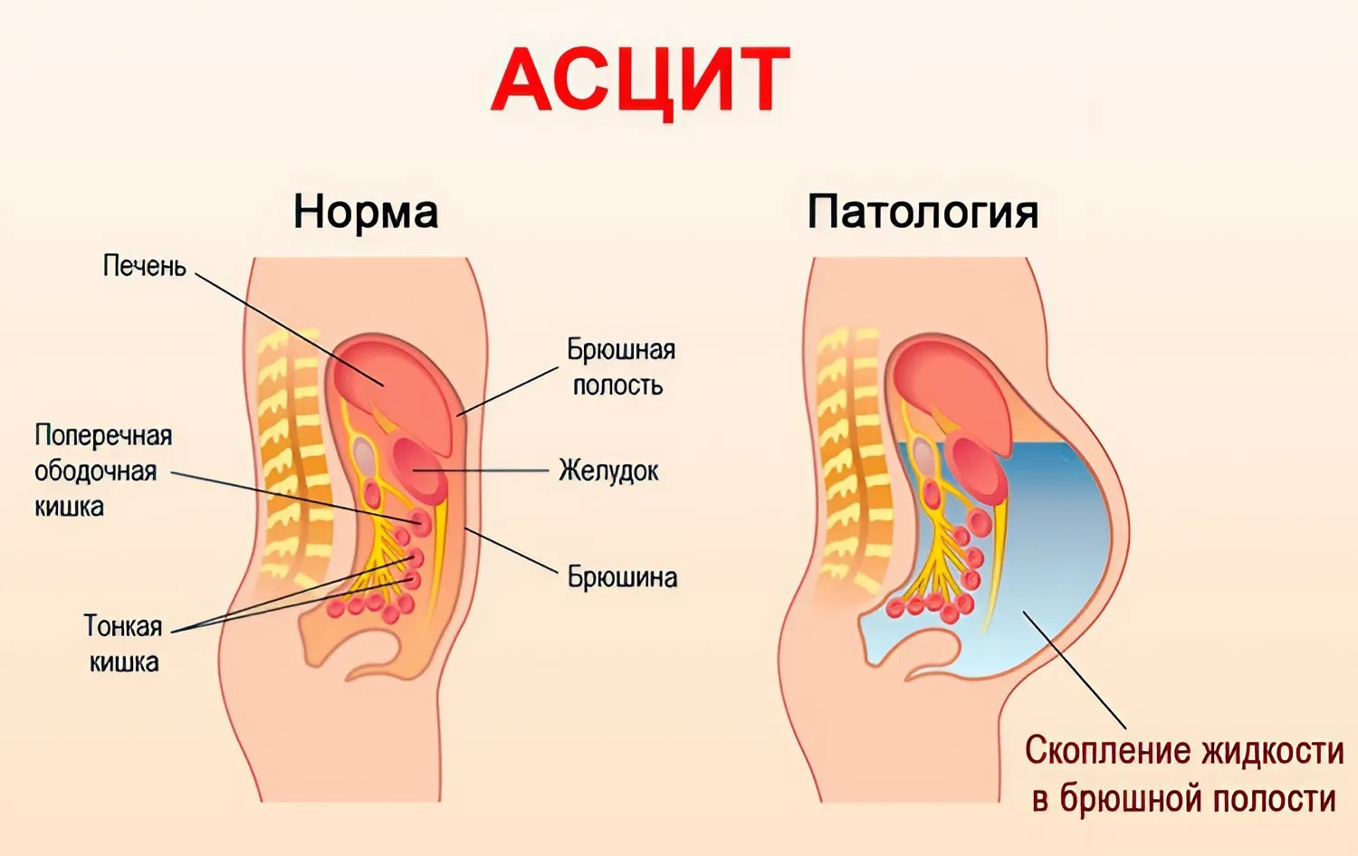 Мчд что это и для чего. Скопилась жидкость в брюшной полости. В животе скапливается жидкость. Жидкости в порси живота.