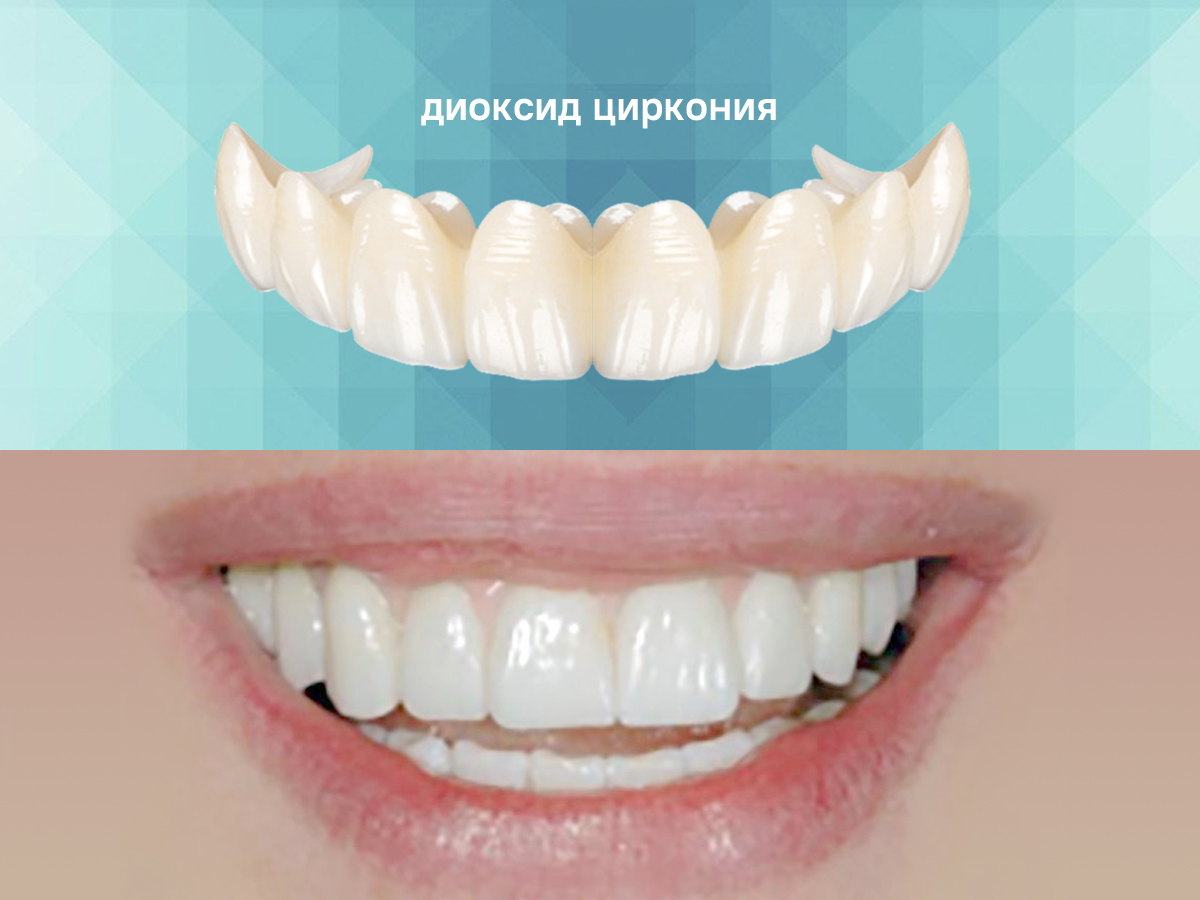 Реставрация зубов — коронки, виниры в Пушкино и Королеве — стоматология  Future Smile