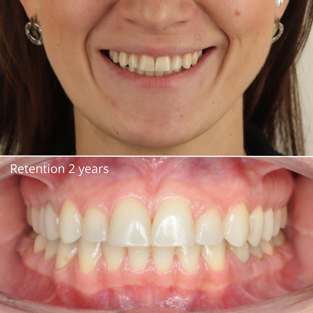 Stage showing the occlusal plane leveling as intrusion progresses — photo 3 of 5