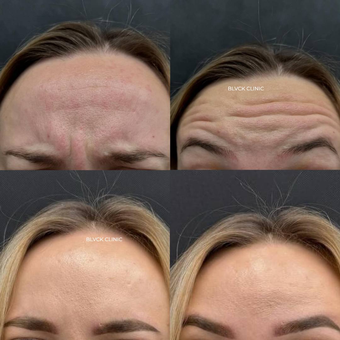 До и после ботокса в Blvck Clinic Питер