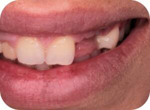 До имплантации