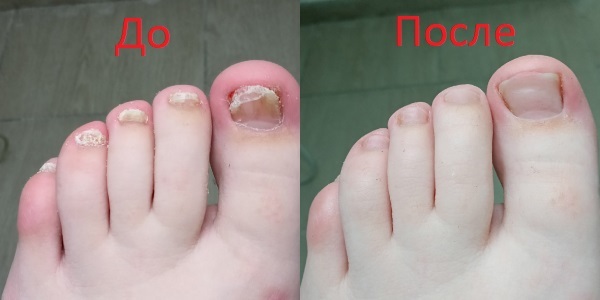 Ногти до лечения грибка и после