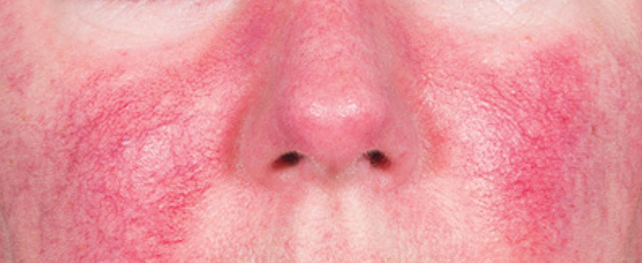 Красные пятна и прыщики на лице: чем опасна розацеа и как с ней бороться?