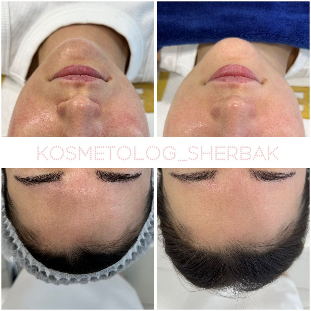 Фотодинамическая терапия (ФДТ) в клинике Прадус