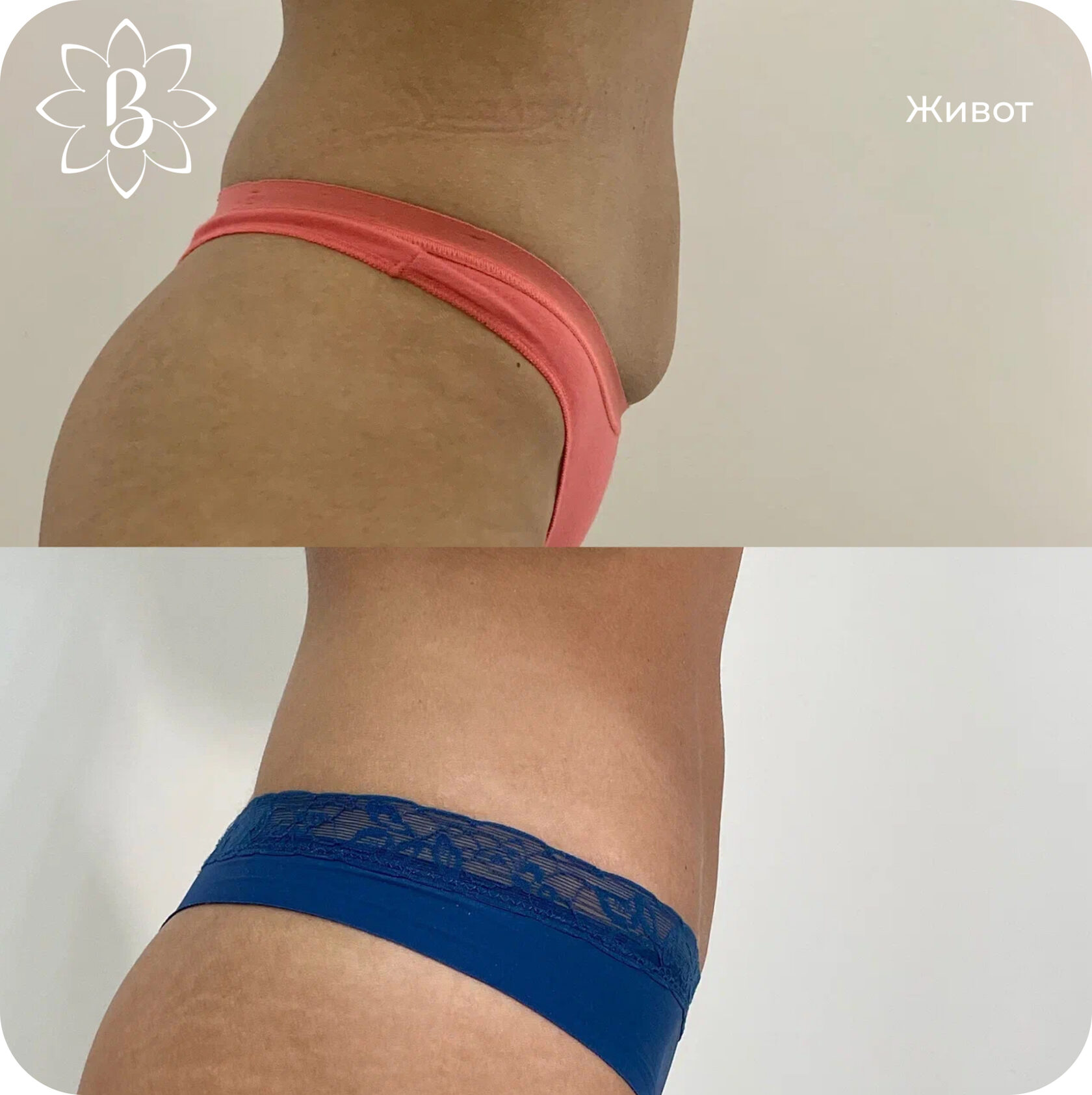 Диодная лазерная эпиляция