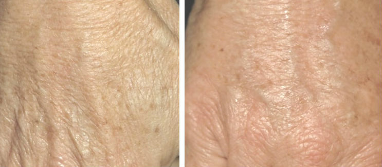 Фото 2. PRP-терапия омоложения рук до и после
