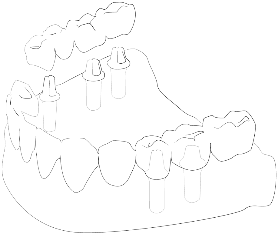 Имплантация