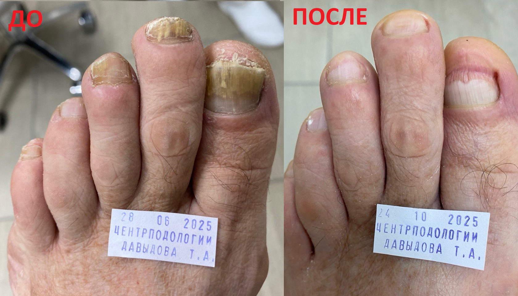 Ногти на ногах до лечения грибка и после