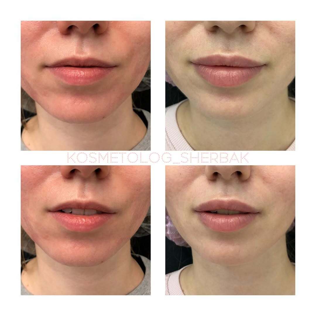 До и после контурной пластики губ. Увеличение объёма без утяжеления. PradusCOSMO, Васильевский остров