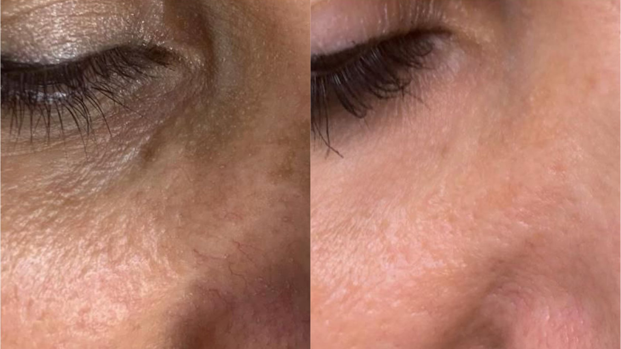 Фото до и после: удаление сосудов лазером в клинике PradusCOSMO, Санкт-Петербург. Безопасно, эффективно и без повреждений кожи