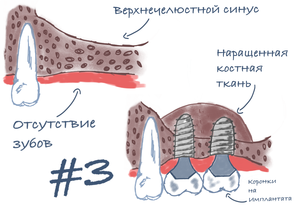 Наращивание кости отзыв