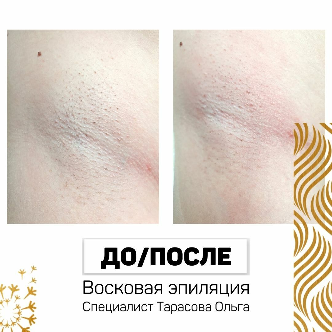 Сколько Стоит Депиляция В Москве
