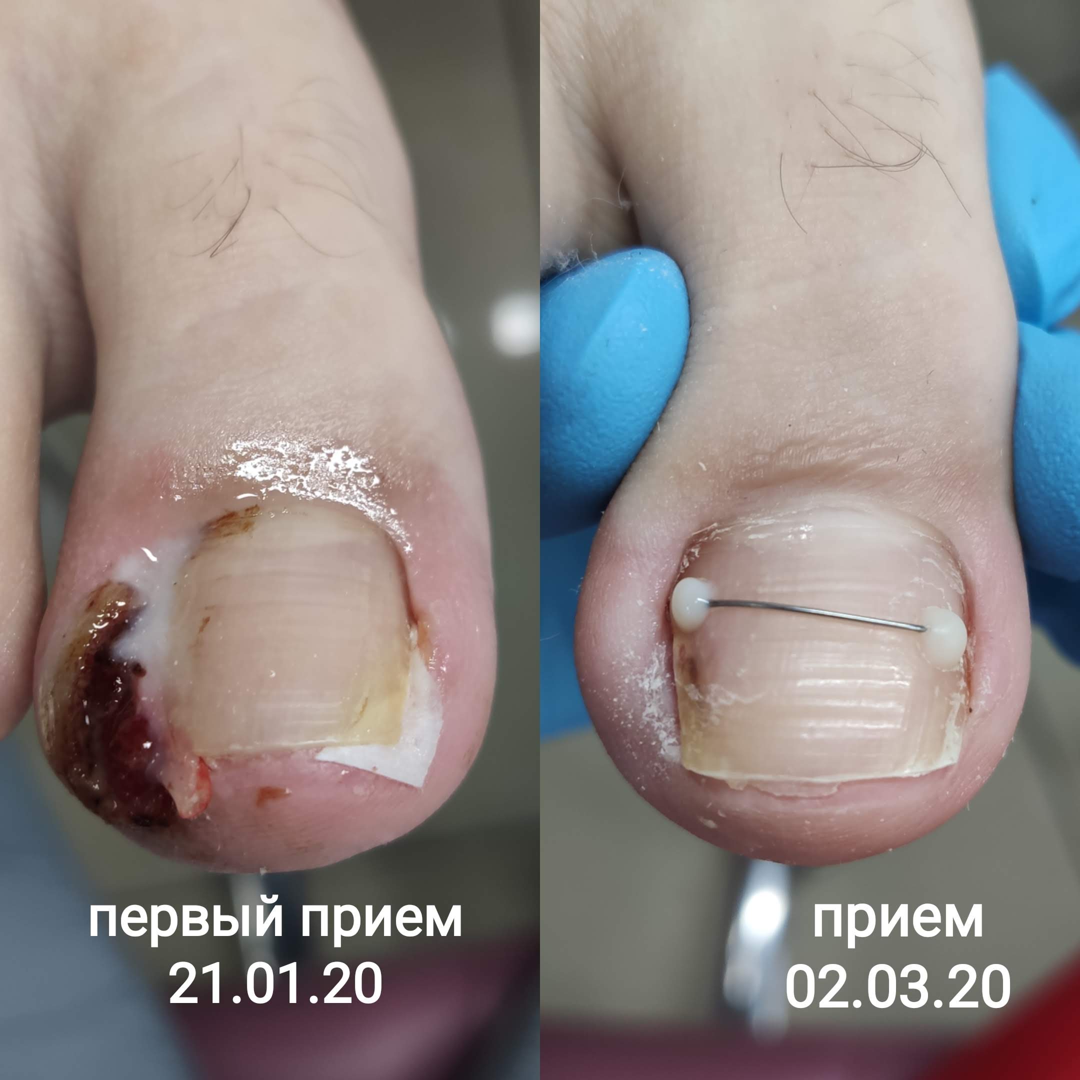 Лечение и удаление вросшего ногтя в Перми без боли по доступной цене ...
