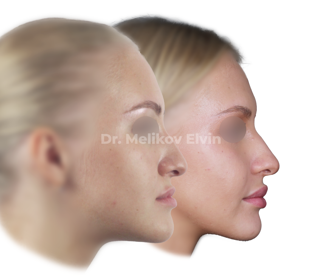 Фотографии до и после ортогнатической операции.