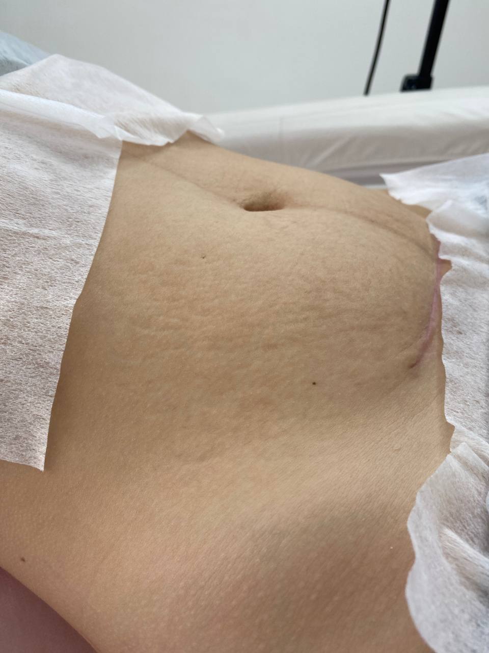 удаление растяжек восстановление живота после родов и беременности