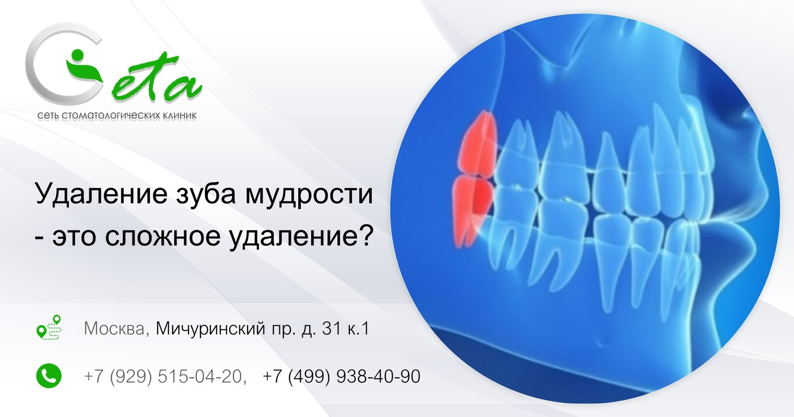 Удаление зуба мудрости - сложное удаление - стоматология в Раменках