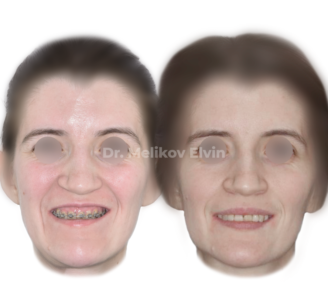 Фотографии до и после ортогнатической операции.