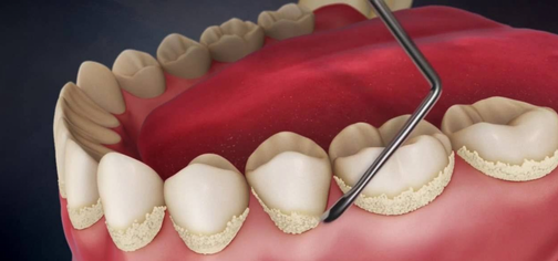 Зубной камень: как образуется, уход и профилактика