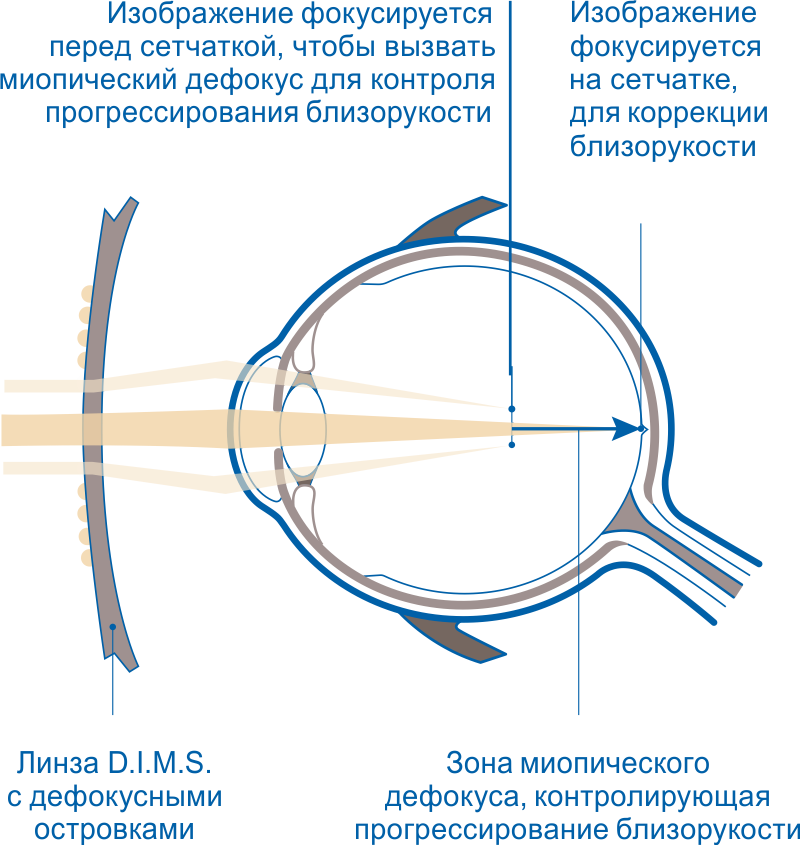 Линзы стеллест очковые отзывы. Stellest линзы очковые. Miyosmart линзы для очков. Миопия линзы.