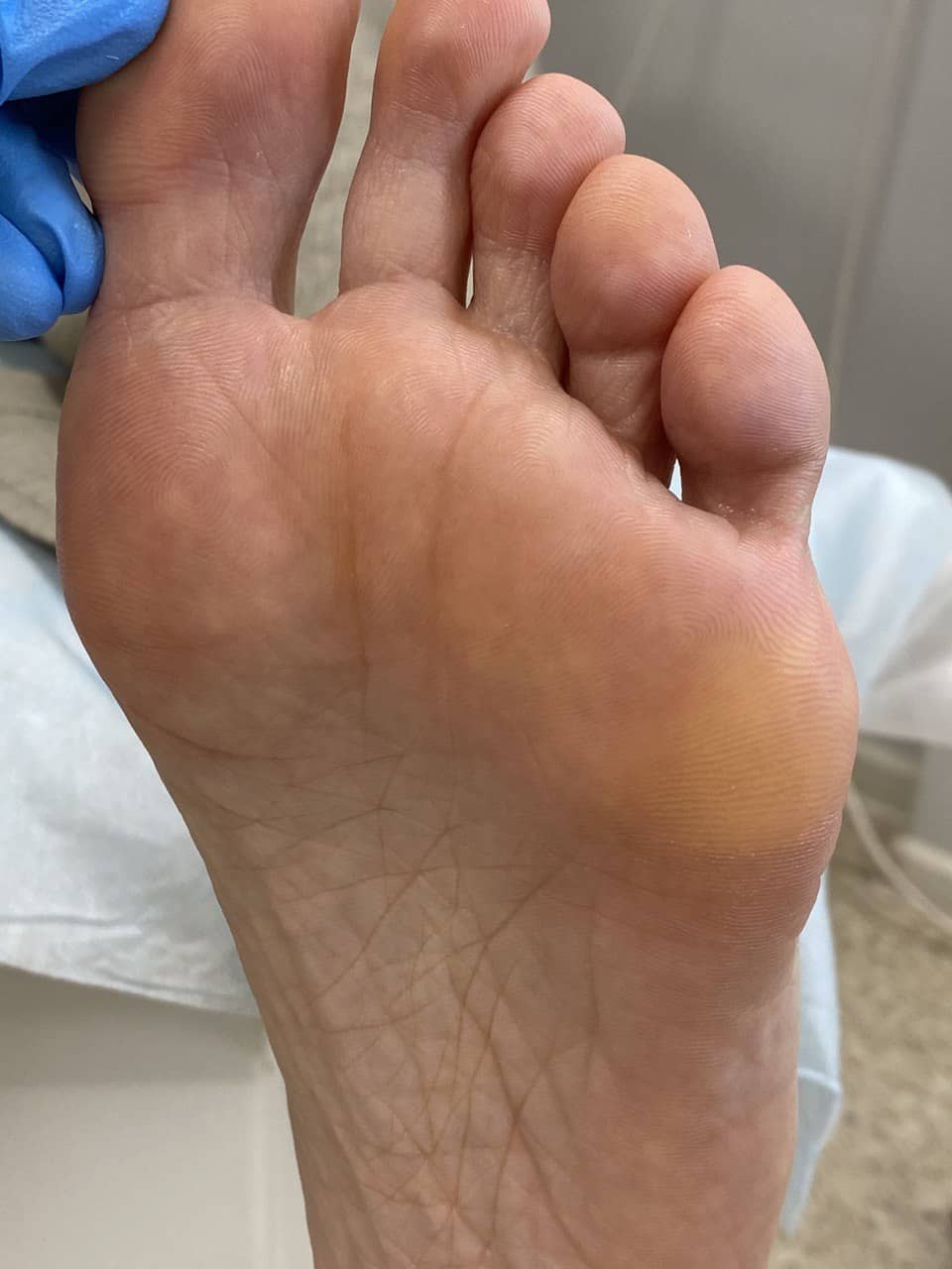 Натоптыши на ступнях